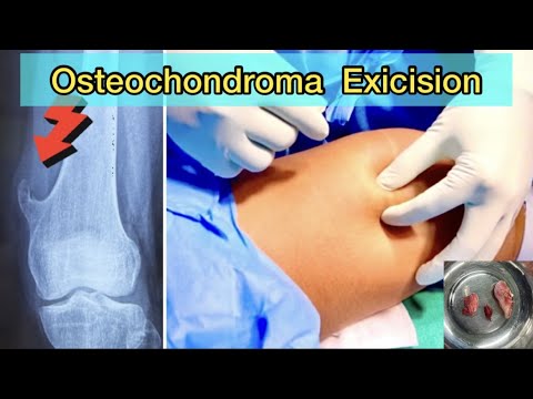 OSTEOCHONDROMA EXCISION | SOLITARY PEDUNCULATED EXOSTOSIS | BENIGN TUMOR OF BONE | SURGICAL TRICKS