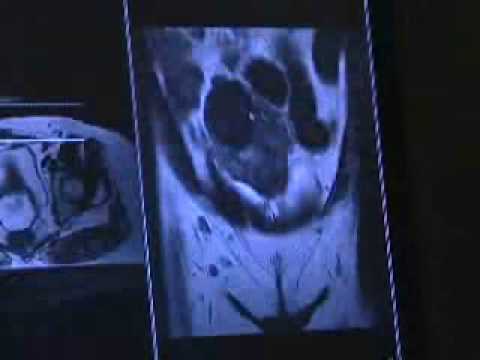 Uterine Artery Embolization at Rex Healthcare - Rex HealthBreak