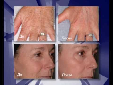 Лазерное омоложение кожи и лечение рубцов