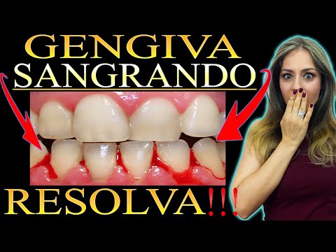 Vídeo: Sangramento Nas Gengivas Da Dip: Isso Pode Ser Um Efeito Do Tabaco De Mascar?