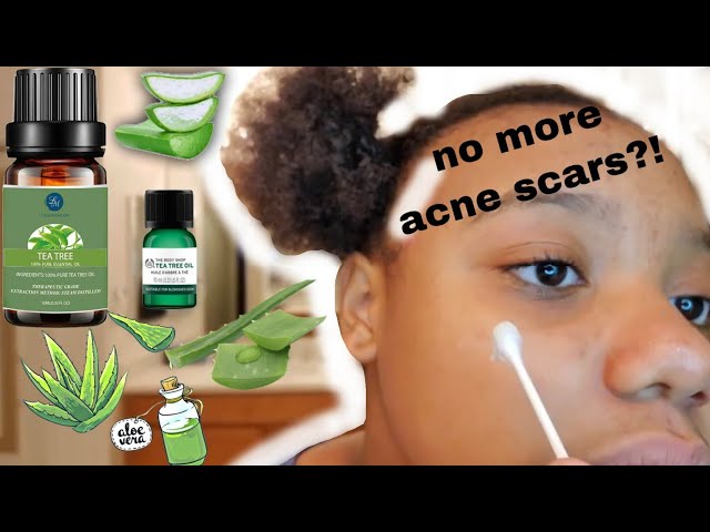 tea tree oil acne scars