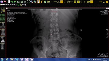 Viztek   20 20 Imaging Opal Rad Chiropractic Cobb Angle Tool