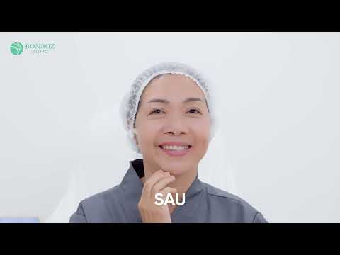 Khách U60 sau một lần căng chỉ Fiber Lift — ghi hình tại phòng khám