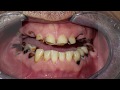 Smiles Beyond the Bars Life Changing Teeth Transformation