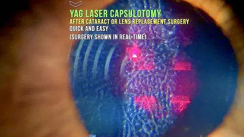 Everything you need to know about YAG LASER Capsulotomy in 30 seconds.