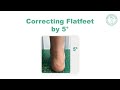 Correcting Flat Feet by 5° | How Orthotics Improve Foot Alignment