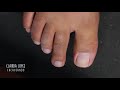 Cutilagem completa dos pés