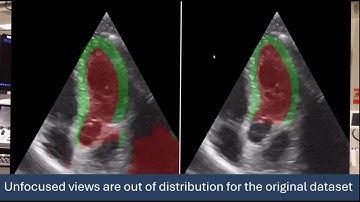 Generative augmentations for improved cardiac ultrasound segmentation using diffusion models