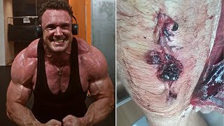 This Bodybuilder Might Lose His Leg