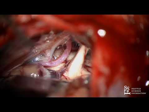 Vídeo: Neuropatia Trigeminal