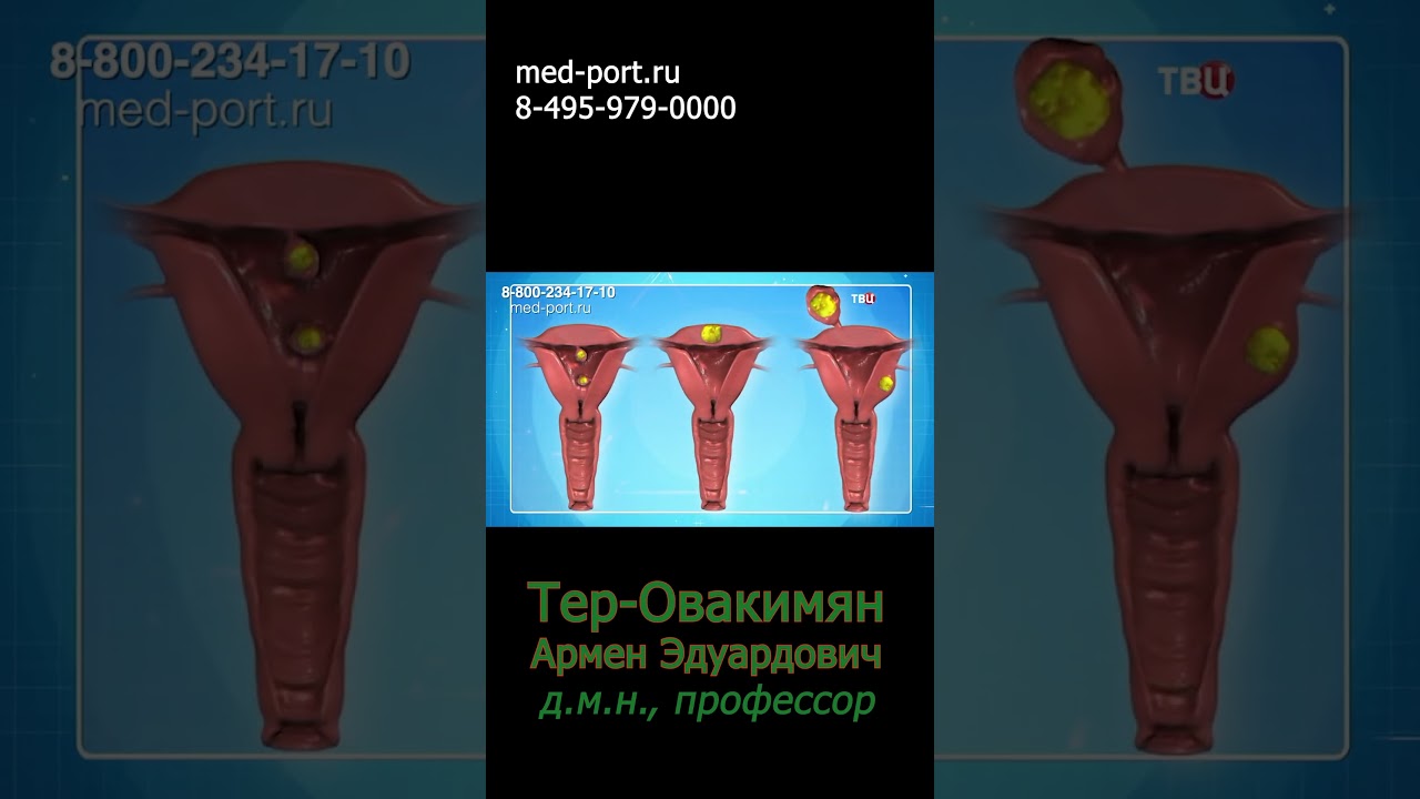 Миома матки: какие узлы самые опасные и безопасные?
