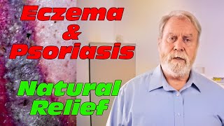 Natural Relief From Eczema and Psoriasis
Are you tired of battling with skin conditions like psoriasis, eczema, nail fungus, itchy scalp, dandruff, hair loss, body odor, and hemorrhoids? Well, worry no more. A natural solution thats safe, effective, and has been used for centuries is here. Andrographis paniculata herbal cream bar. Andrographis paniculata, also known as the king of bitters and Fahtalaijon, is a herb that has been used in traditional medicine in Thailand, India, and China for centuries. It is known for its anti-inflammatory and anti-microbial properties, making it a potent herbal remedy to help treat many skin conditions.
Lets dive into the different skin conditions that can be effectively treated with Fahtalaijon herbal bar. First, lets talk about dandruff and itchy scalp. The herbal cream bars anti-microbial properties help reduce the fungi that cause dandruff and its anti-inflammatory properties to the scalp, reduce irritation, and prevent itchiness. Moving on to eczema, which is characterized by inflamed, itchy, and flaky skin, Fahtalaijon herbal cream bars anti-inflammatory effects help reduce redness, swelling, and itchiness while keeping the skin moisturized, preventing breakouts and accelerating the healing process. Psoriasis can cause thick scaly patches that can be painful and itchy. The anti-inflammatory compounds of Fahtalaijon herbal cream bar help reduce the severity and duration of the disease, unclog pores that soothe the skin, leading to a quick recovery. Fahtalaijon herbal cream bar is also effective in treating foot and toe nail fungus, which is usually caused by moisture buildup or inadequate drying of the feet.
The herbal cream bar has anti-fungal properties that help kill the root of the fungus, leading to the natural growth of healthy nails. In addition, the herbal cream bar, with its natural anti-microbial properties, can help curb body odor by killing odor-causing bacteria that thrive in sweat-prone areas, keeping the body smelling fresh and clean. Finally, we have hemorrhoids, a painful and uncomfortable condition. Fortunately, Fahtalaijon herbal cream bars anti-inflammatory properties can help reduce the pain and itching, which reduces the need to scratch and in turn, minimizes the possibility of bacterial or fungal infections.
Now that weve discussed how Fahtalaijon herbal cream bar can help various skin conditions, lets look at how to use it properly to achieve maximum benefits. The first and most important step is to use it during a dry wash. Apply the herbal cream bar directly to the affected area by lathering it up before applying. Leave it on for at least 15 minutes before washing off. Repeat the process twice a day for the best results. For better results, its essential to suspend or stop using chemical-based products and creams completely, since they may have aggressive ingredients that promote inflammation and aggravate skin issues.
Fahtalaijon herbal cream is available in bar form. It looks like a bar of soap, but remember one thing. Its not soap. Its 100% organic, chemical-free compressed herbal bar, which lathers up to form a cream. Incorporating Fahtalaijon herbal cream bar into your daily skincare routine, you take a step towards healthier skin and a happier life.
I hope you found the information in this video useful. Before winding up, if you would like to obtain Fahtalaijon herbal cream bars, you can purchase it from an authorized distributor of Tawandeaun Premium Herbal Products.
https://www.tawanduan.com.au/andrographis-paniculata
Chapters:
00:00:00 Intro
00:00:46 Dandruff
00:01:03 Eczema
00:01:23 Psoriasis
00:01:42 Toe nail fungus
00:02:02 Body Odor
00:02:17 Hemorrhoids
00:02:38 How to use
00:02:37 How to order
https://thaiaussies.com/herbal-health-soap/
Credits and attributions:
Images
https://commons.wikimedia.org/wiki/File:Stasis_dermatitis_(Gravitational_eczema).jpg
https://commons.wikimedia.org/wiki/File:Nagelpilz-3.jpg
https://commons.wikimedia.org/wiki/File:Excessive_dandruff.jpg
#FahtalaijonHerbalBar Natural Relief From Eczema and Psoriasis
