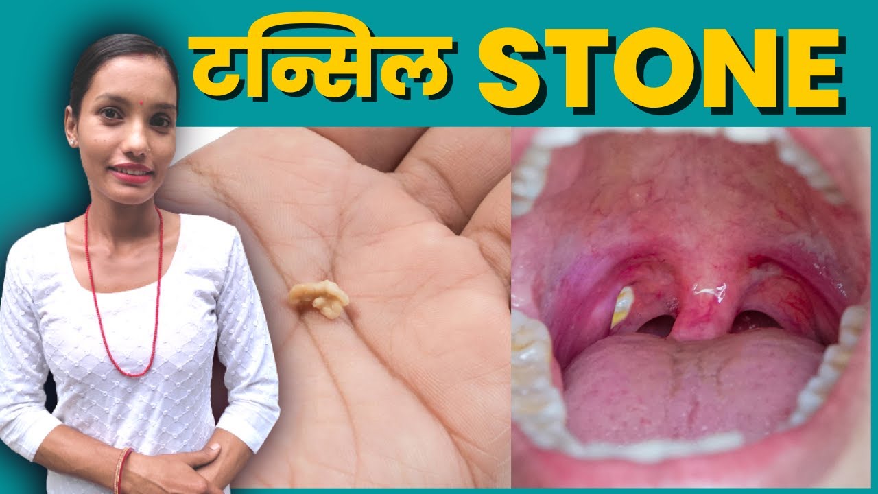 tonsil stones removal at home medicine in nepali language . YouTube