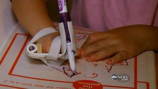 Girl Scouts Invent Prosthetic Hand Device
