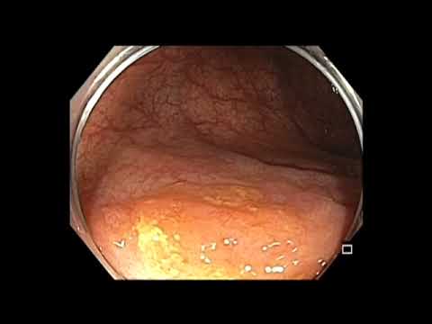 Ascending colon subtle lesion hiding behind a fold