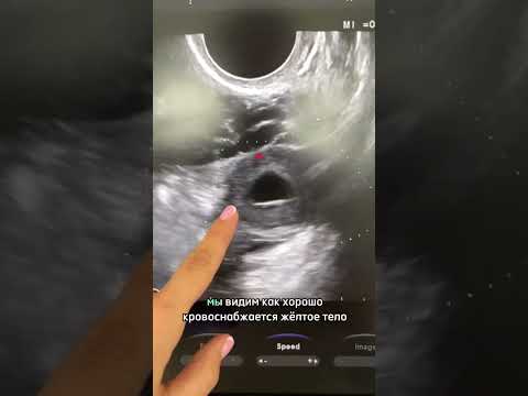 Как выглядит беременность 🤰 на ранних сроках?