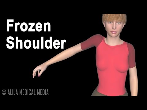 Frozen Shoulder (Adhesive Capsulitis), Animation.