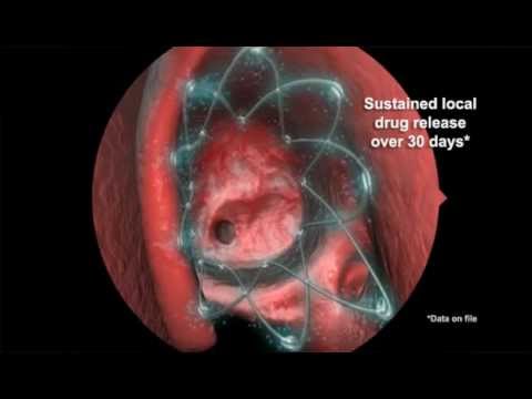 Propel steroid eluting stent