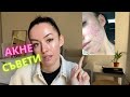 АКНЕ | За акнето и колко важна е основната грижа за кожата - Част 1 #SkincareEducationbyBewell