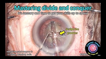 CataractCoach™ 2089: mastering divide and conquer phaco technique