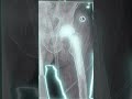 “Femoral Neck Fracture – Why Hip Replacement Is the Best Treatment” #medicalshorts