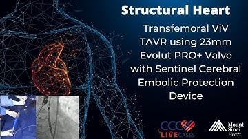 Transfemoral ViV TAVR using 23mm Evolut Pro+ Valve - May 2021