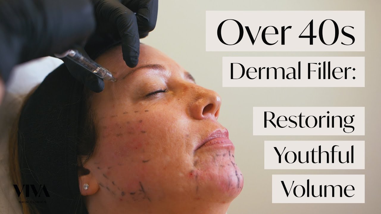 Dermal Filler for Over 40s 💆‍♀️ Restoring Youthful Volume YouTube