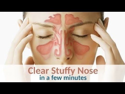 8 Ways to Clear a Stuffy Nose Naturally