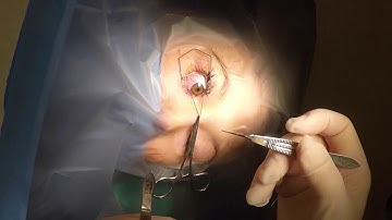 Botox to extra ocular muscle (EOM) strabismus surgery