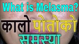 कालो पोतो (Kalo Poto) को  बारेमा || What is Melasma ? || कालो पोतो कसरी हुन्छ ? || by  Dr  Kalyan