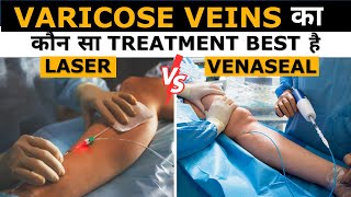 Laser vs Venaseal For Varicose Veins | in Hindi | Dr. Gaurav Gangwani