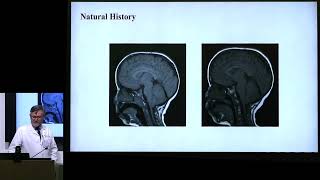 Long Term Health with Chiari Malformation - Dr Cormac Maher