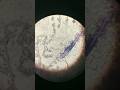 Platelet Clumps