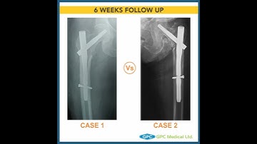 Inter-Trochanteric Fractures Series - PART 2 | GAITS | GPC Medical Ltd.
