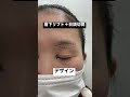 30代女性、眉下&目頭切開で隠れた二重が出現☆