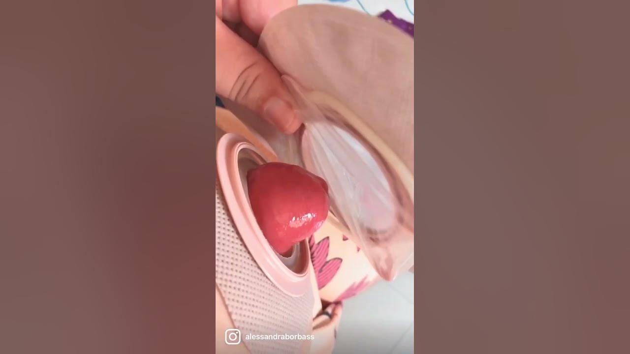 Camisinha na bolsa de ostomia Camisinha na bolsa de ostomia
