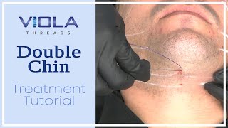 Viola Threads Double Chin Treatment Tutorial