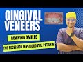 Dr rudra mohan  gingival veneers  reviving smiles in periodontal patients with gingival recession