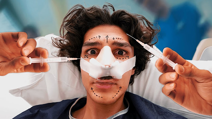 TOUT SUR MA RHINOPLASTIE !