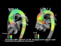 4-D MRI flow