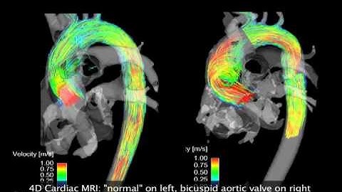 4-D MRI flow