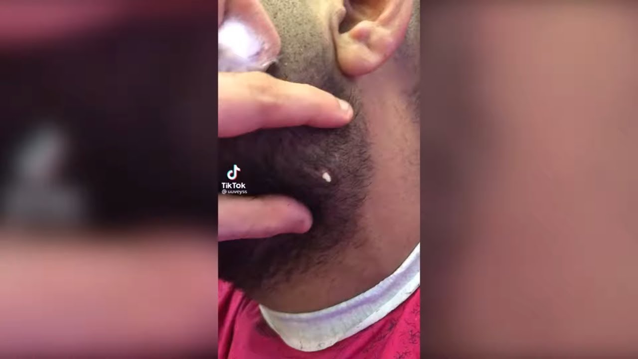 Popping huge blackheads and Pimple Popping - Best Pimple Popping Videos #20