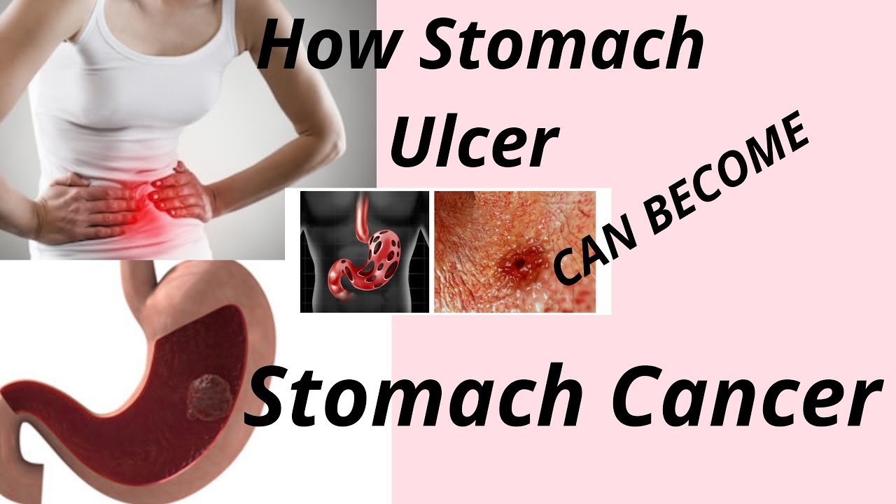 HOW STOMACH ULCER CAN TURN TO STOMACH CANCER - YouTube