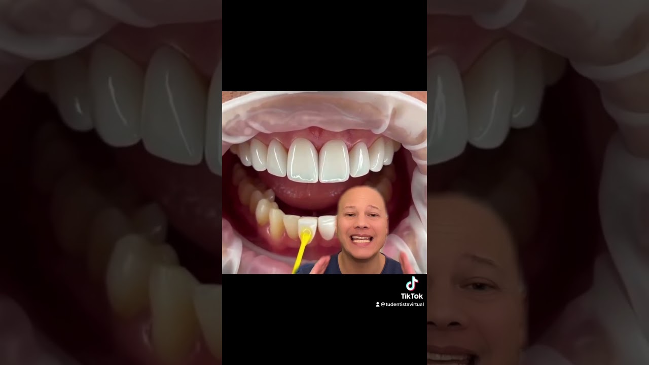 Carillas dentales de cerámica, debes saberlo…