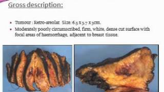 Angiosarcoma of the Breast screenshot 3