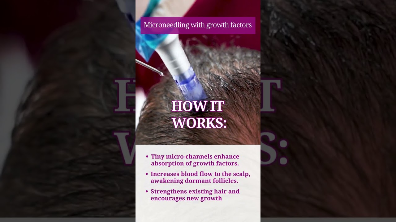 🌱 Microneedling with Growth Factors for Hair Loss 🌿