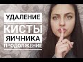 Лапароскопия яичника. Эндометриоидная киста. Часть 2