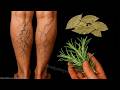 You&rsquo;ll NEVER Believe What Erased My Varicose Veins! 🤯 2 Home Remedies 🌿🍀