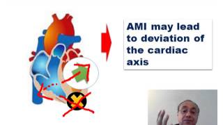 ECG CARDIAC AXIS  #usmle #internal_medicine #cme #medicaleducation #ecg  #محاضرات_باطنة #medical screenshot 2