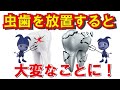 放置された重度のむし歯の治療!! Treatment For Severe Tooth Decay !!